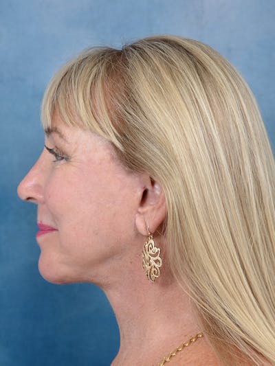 Deep Plane Facelift Before & After Gallery - Patient 142680785 - Image 10