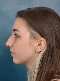 Rhinoplasty Before & After Gallery - Patient 142680800 - Image 1