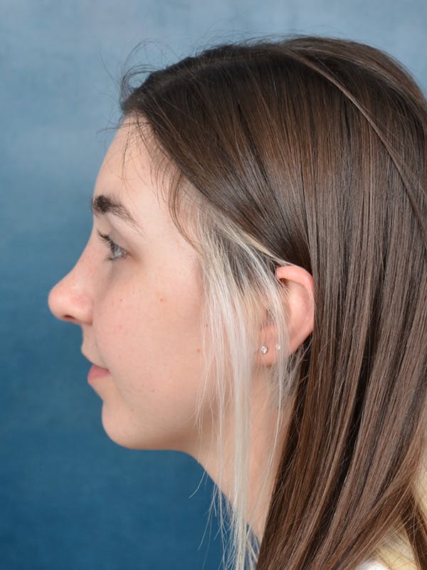 Rhinoplasty Before & After Gallery - Patient 142680800 - Image 2