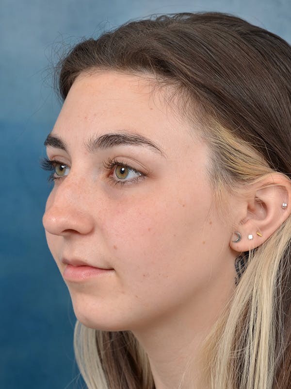 Rhinoplasty Before & After Gallery - Patient 142680800 - Image 3
