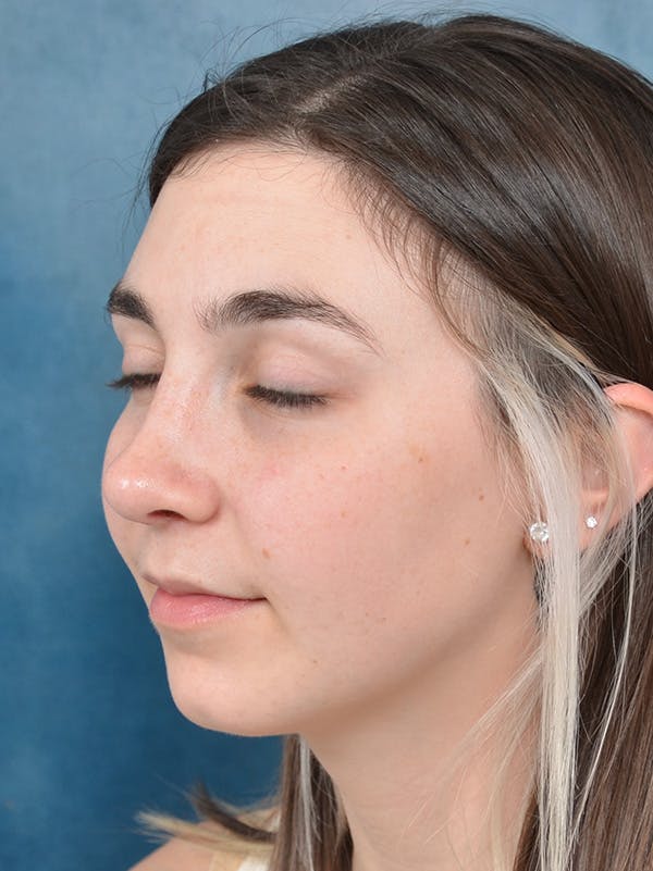 Rhinoplasty Before & After Gallery - Patient 142680800 - Image 4