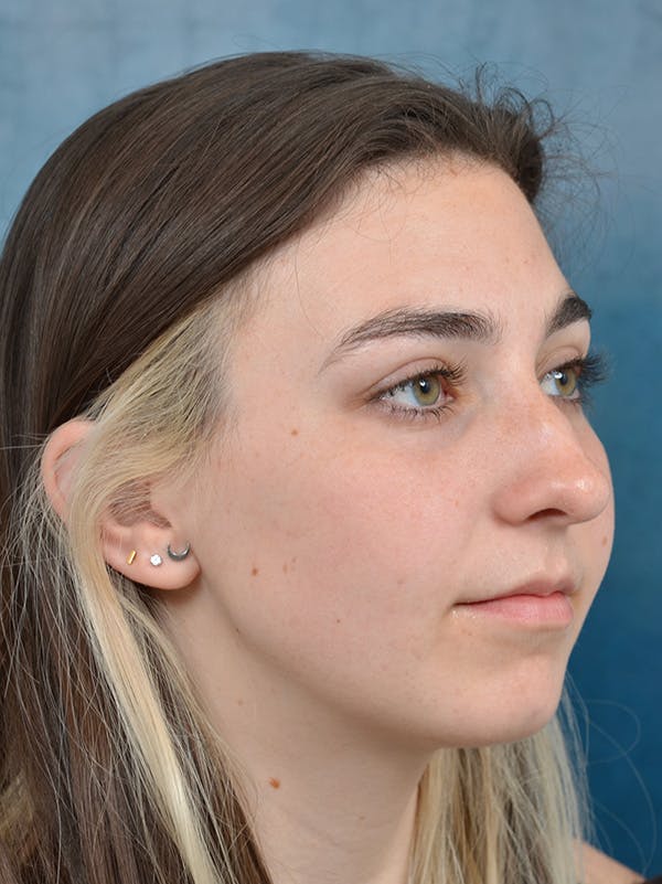 Rhinoplasty Before & After Gallery - Patient 142680800 - Image 7