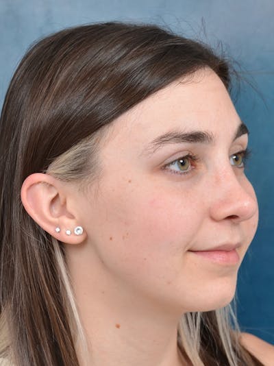 Rhinoplasty Before & After Gallery - Patient 142680800 - Image 8