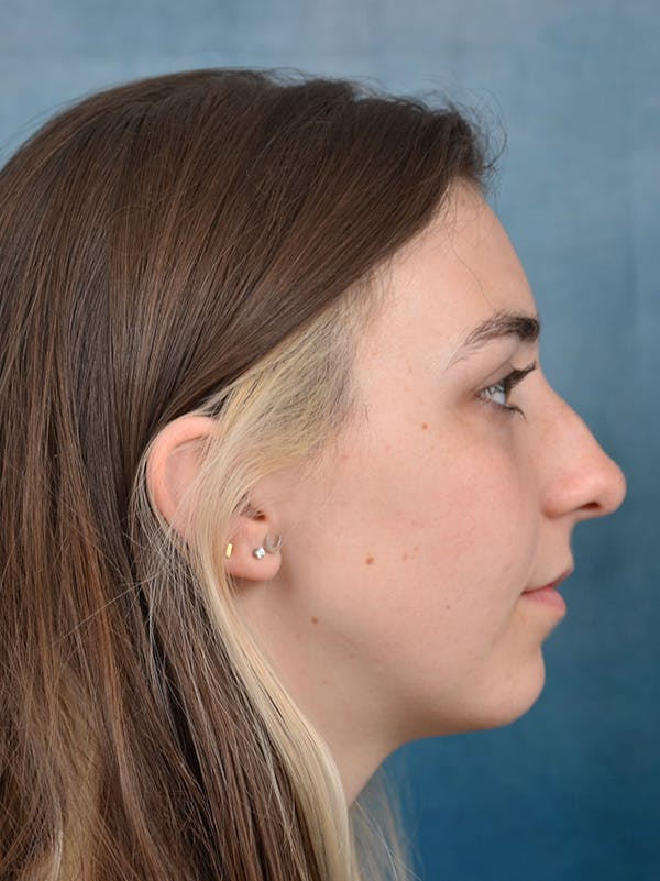 Rhinoplasty Before & After Gallery - Patient 142680800 - Image 9