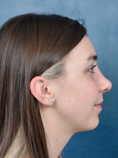 Rhinoplasty Before & After Gallery - Patient 142680800 - Image 10