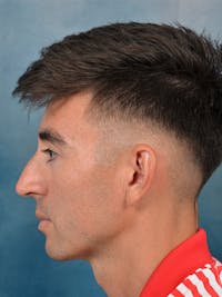 Rhinoplasty Before & After Gallery - Patient 142680809 - Image 1