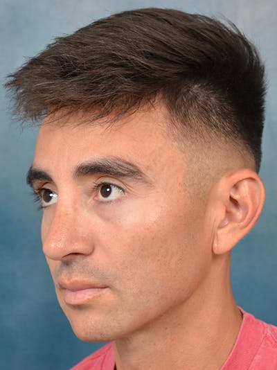 Rhinoplasty Before & After Gallery - Patient 142680809 - Image 4