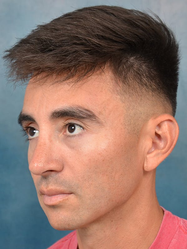 Rhinoplasty Before & After Gallery - Patient 142680809 - Image 4