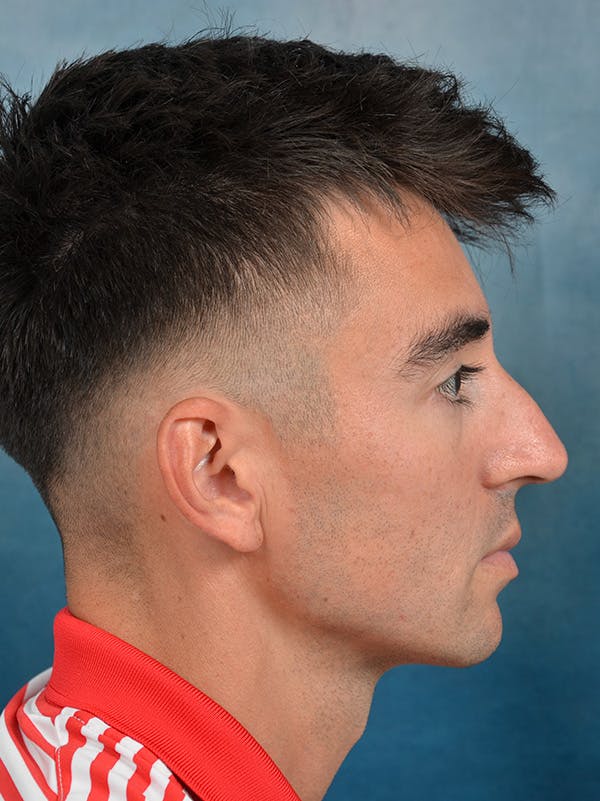 Rhinoplasty Before & After Gallery - Patient 142680809 - Image 9