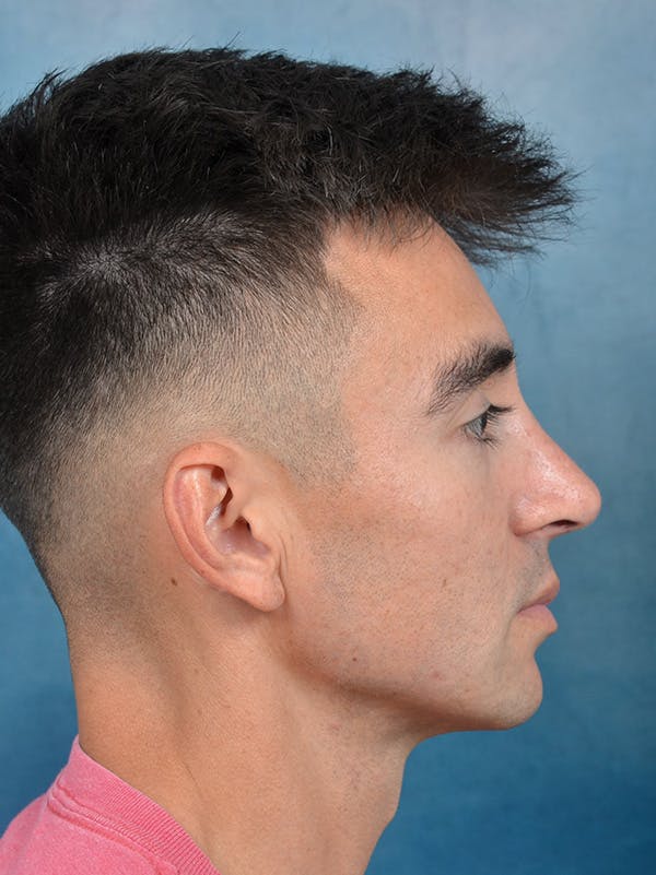 Rhinoplasty Before & After Gallery - Patient 142680809 - Image 10