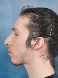 Rhinoplasty Before & After Gallery - Patient 142680810 - Image 1