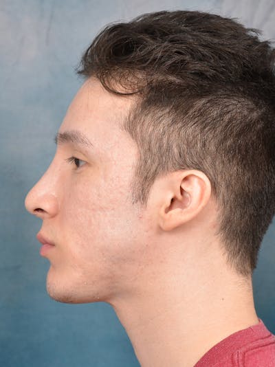 Rhinoplasty Before & After Gallery - Patient 142680810 - Image 2