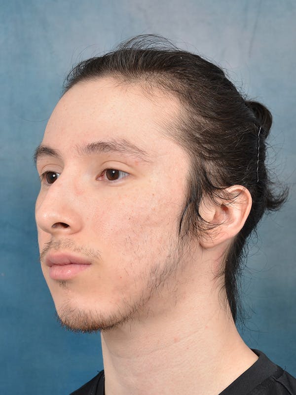 Rhinoplasty Before & After Gallery - Patient 142680810 - Image 3