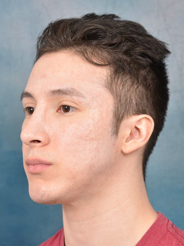 Rhinoplasty Before & After Gallery - Patient 142680810 - Image 4
