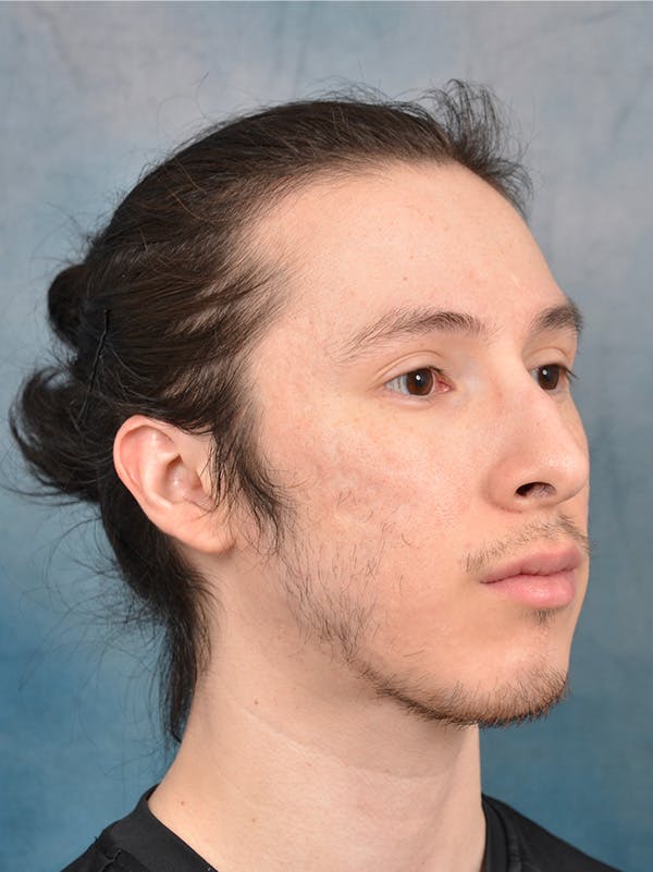 Rhinoplasty Before & After Gallery - Patient 142680810 - Image 7