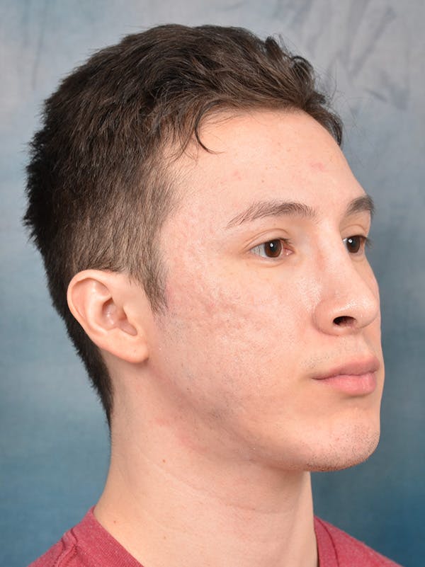 Rhinoplasty Before & After Gallery - Patient 142680810 - Image 8