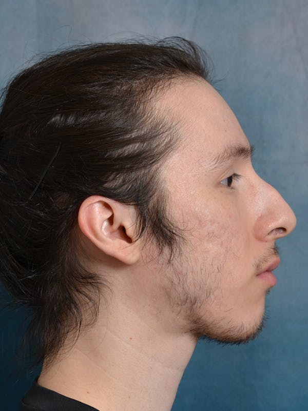 Rhinoplasty Before & After Gallery - Patient 142680810 - Image 9