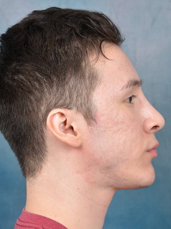 Rhinoplasty Before & After Gallery - Patient 142680810 - Image 10