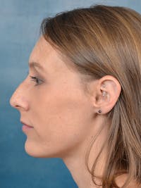 Rhinoplasty Before & After Gallery - Patient 142680801 - Image 1