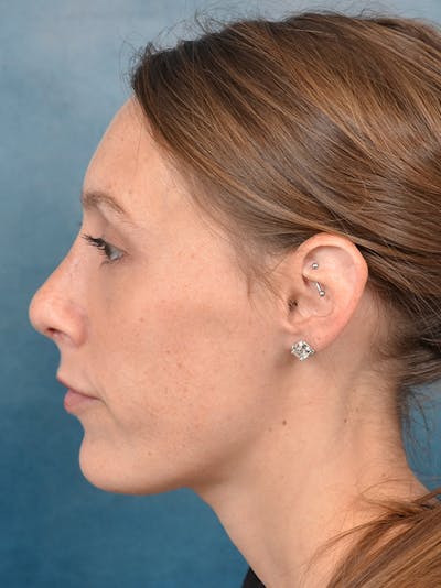 Rhinoplasty Before & After Gallery - Patient 142680801 - Image 2