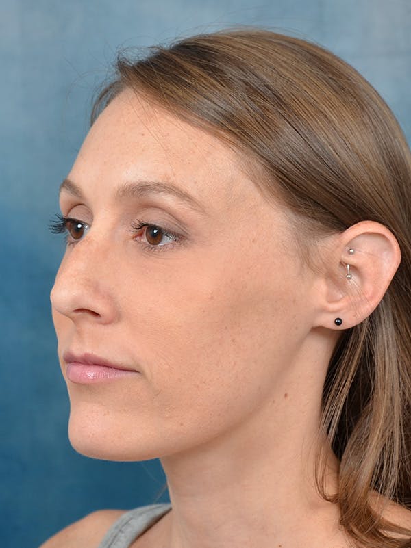 Rhinoplasty Before & After Gallery - Patient 142680801 - Image 3