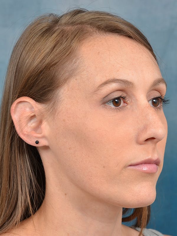 Rhinoplasty Before & After Gallery - Patient 142680801 - Image 7