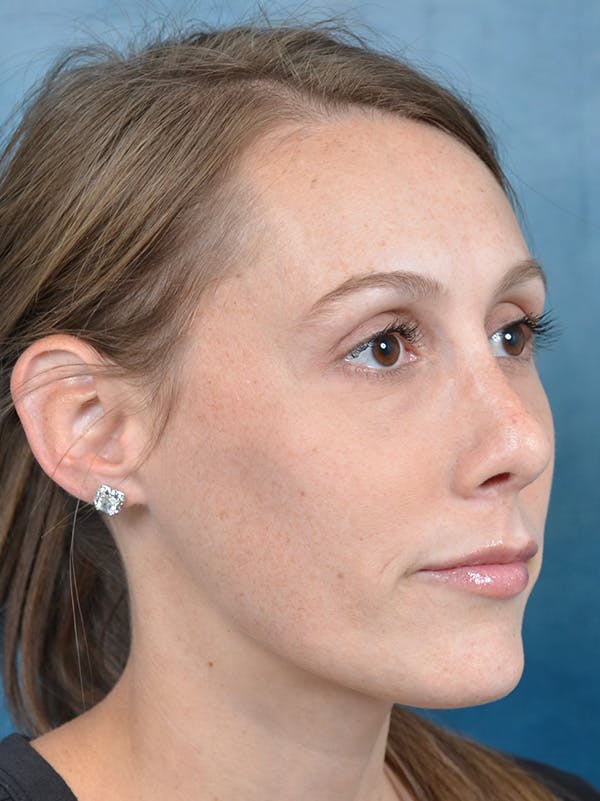 Rhinoplasty Before & After Gallery - Patient 142680801 - Image 8