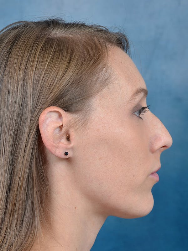 Rhinoplasty Before & After Gallery - Patient 142680801 - Image 9