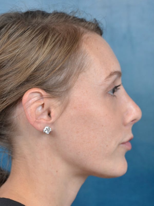 Rhinoplasty Before & After Gallery - Patient 142680801 - Image 10