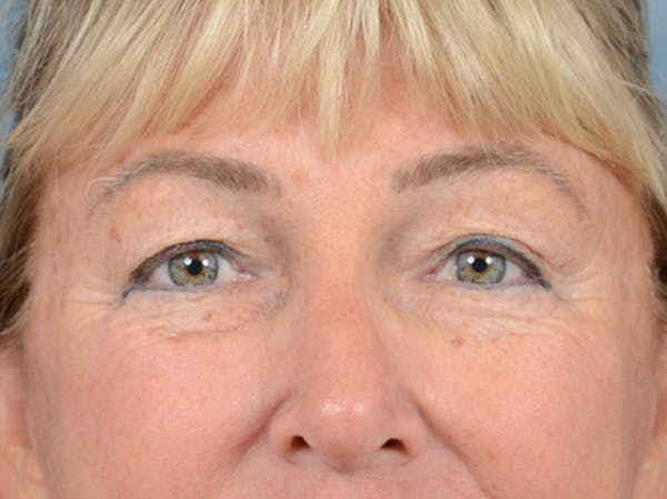 Eyelid Lift Before & After Gallery - Patient 142680791 - Image 1