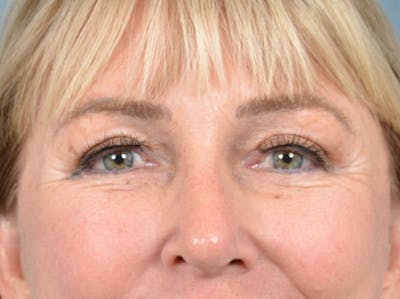 Eyelid Lift Before & After Gallery - Patient 142680791 - Image 2