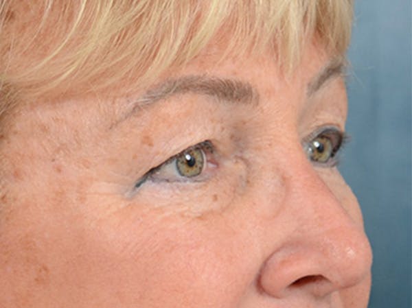 Eyelid Lift Before & After Gallery - Patient 142680791 - Image 3