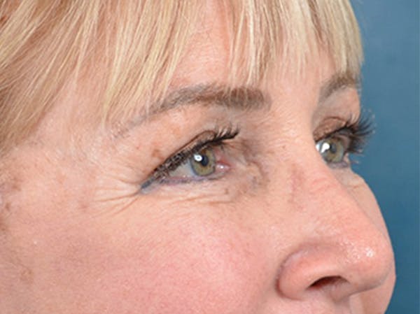 Eyelid Lift Before & After Gallery - Patient 142680791 - Image 4
