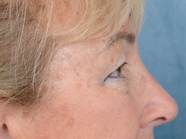 Eyelid Lift Before & After Gallery - Patient 142680791 - Image 5