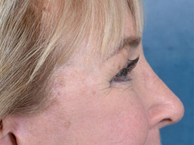 Eyelid Lift Before & After Gallery - Patient 142680791 - Image 6