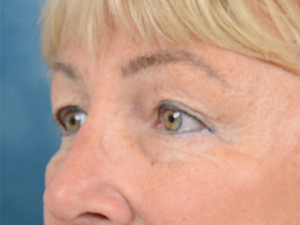 Eyelid Lift Before & After Gallery - Patient 142680791 - Image 7