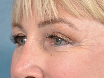 Eyelid Lift Before & After Gallery - Patient 142680791 - Image 8