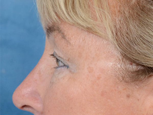 Eyelid Lift Before & After Gallery - Patient 142680791 - Image 9