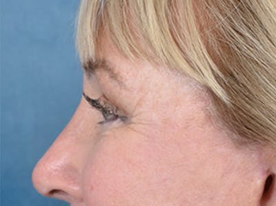 Eyelid Lift Before & After Gallery - Patient 142680791 - Image 10