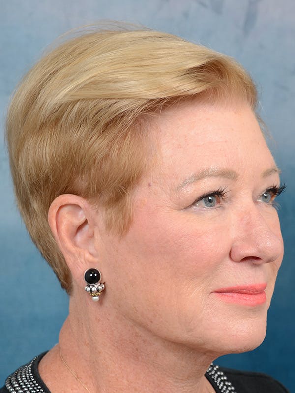 Laser Skin Resurfacing Before & After Gallery - Patient 142705834 - Image 3
