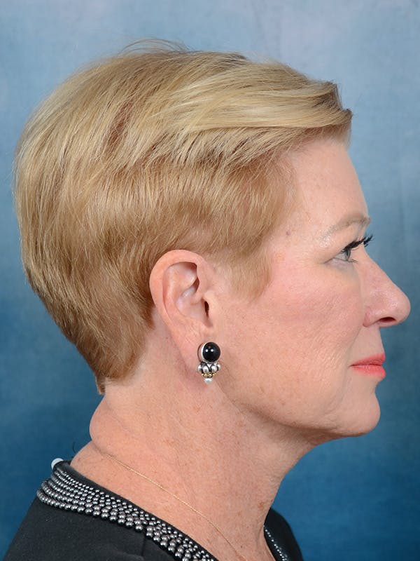 Deep Plane Facelift Before & After Gallery - Patient 142705832 - Image 5