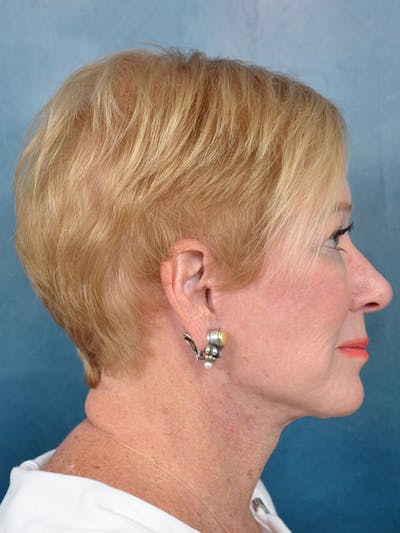 Deep Plane Facelift Before & After Gallery - Patient 142705832 - Image 8