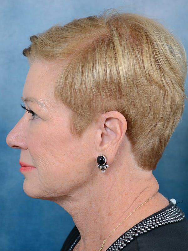 Laser Skin Resurfacing Before & After Gallery - Patient 142705834 - Image 9