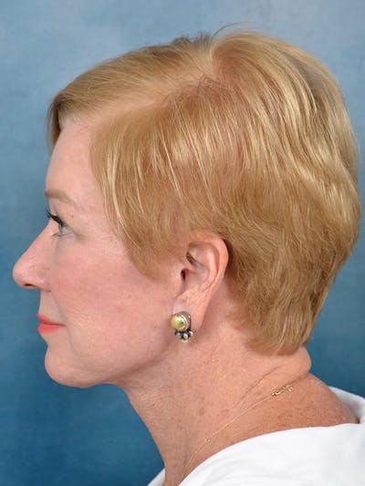 Deep Plane Facelift Before & After Gallery - Patient 142705832 - Image 10