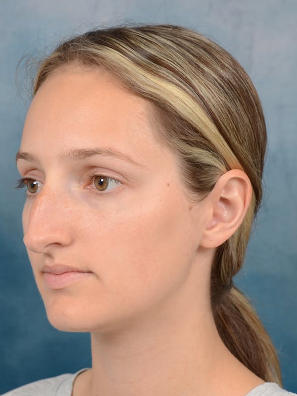 Rhinoplasty Before & After Gallery - Patient 143289390 - Image 3