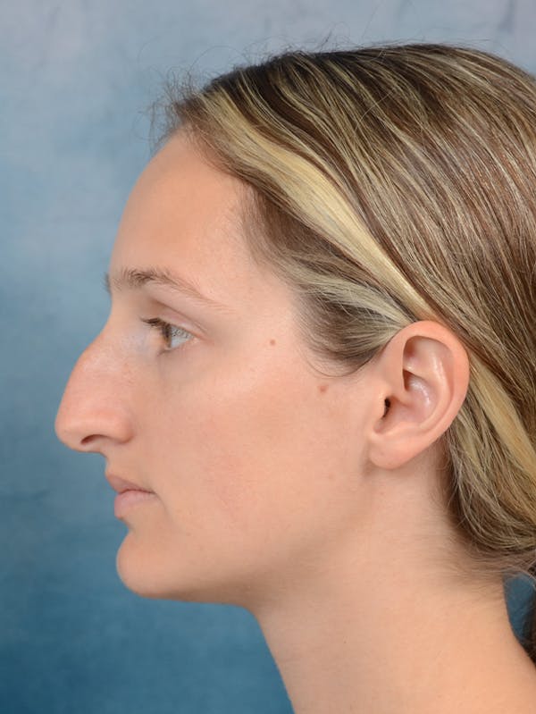 Rhinoplasty Before & After Gallery - Patient 143289390 - Image 1