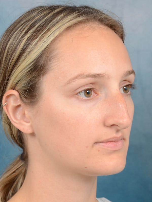 Rhinoplasty Before & After Gallery - Patient 143289390 - Image 7