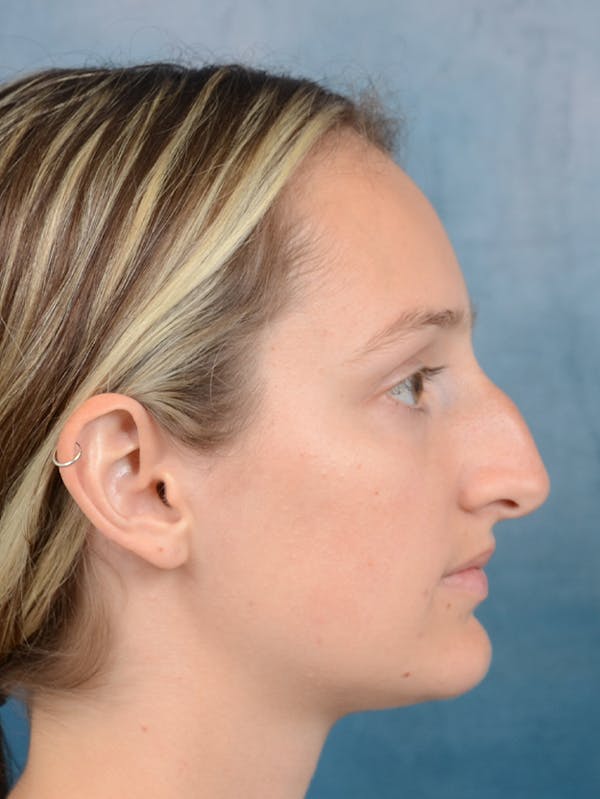 Rhinoplasty Before & After Gallery - Patient 143289390 - Image 9