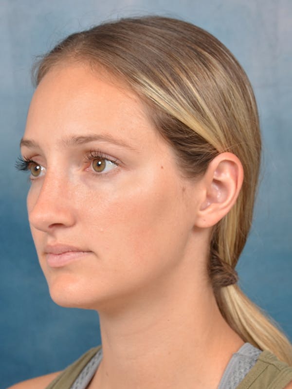 Rhinoplasty Before & After Gallery - Patient 143289390 - Image 4