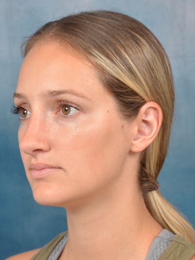 Rhinoplasty Before & After Gallery - Patient 143289390 - Image 4